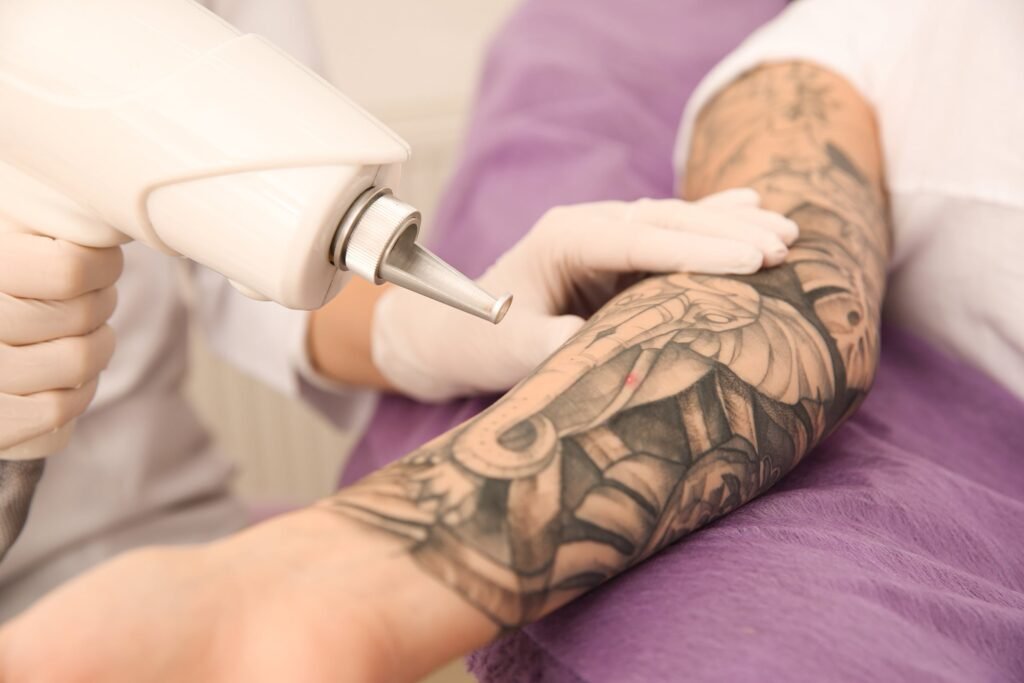 Q-switched laser Teknologi Penghapus Tato Modern yang Aman dan Efektif