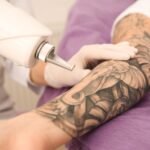 Q-switched laser Teknologi Penghapus Tato Modern yang Aman dan Efektif